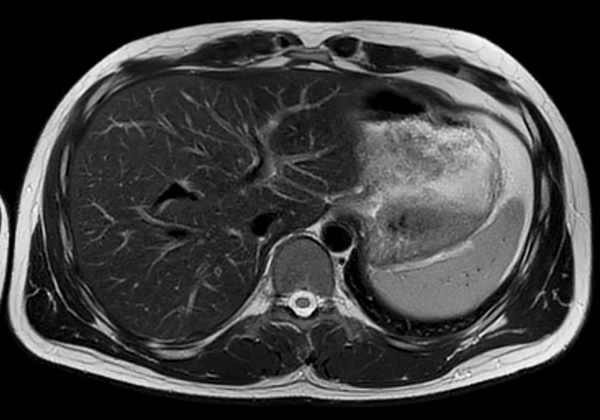 Axial T2w MultiVane XD (high res)